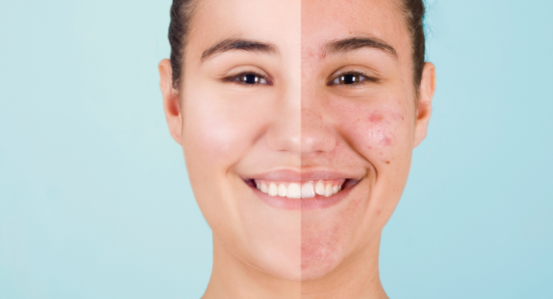 Dermatologa Especialista en acne Queretaro