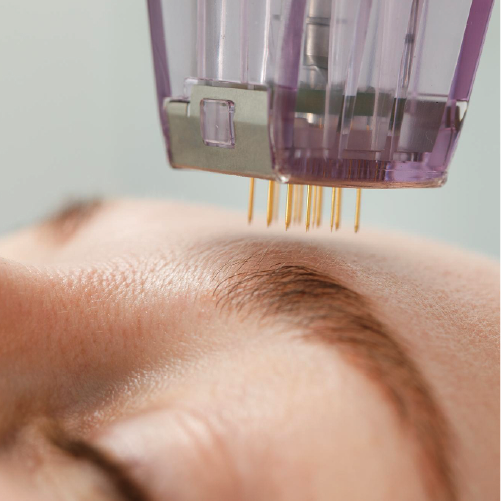 Microneedling capilar precio Queretaro