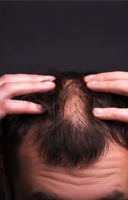 Caída de cabello